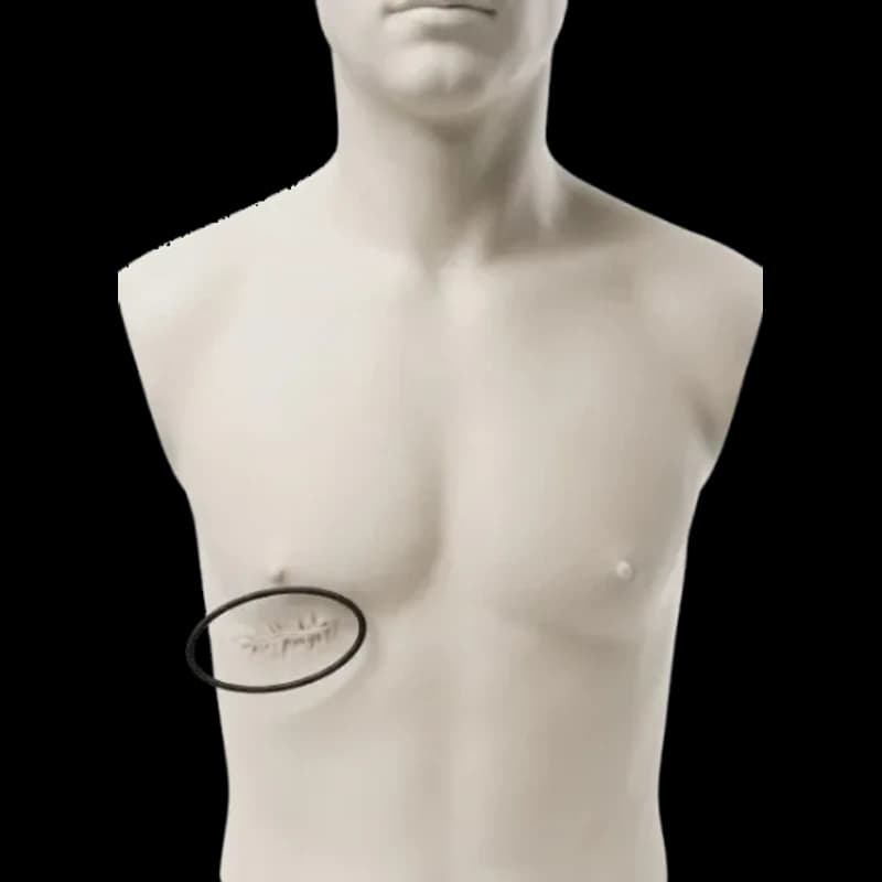 Minimally Invasive Cardiac Surgery (MICS)